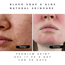 Pimple-Free Skin: Black Soap&#39;s Purity Secret - $12.16