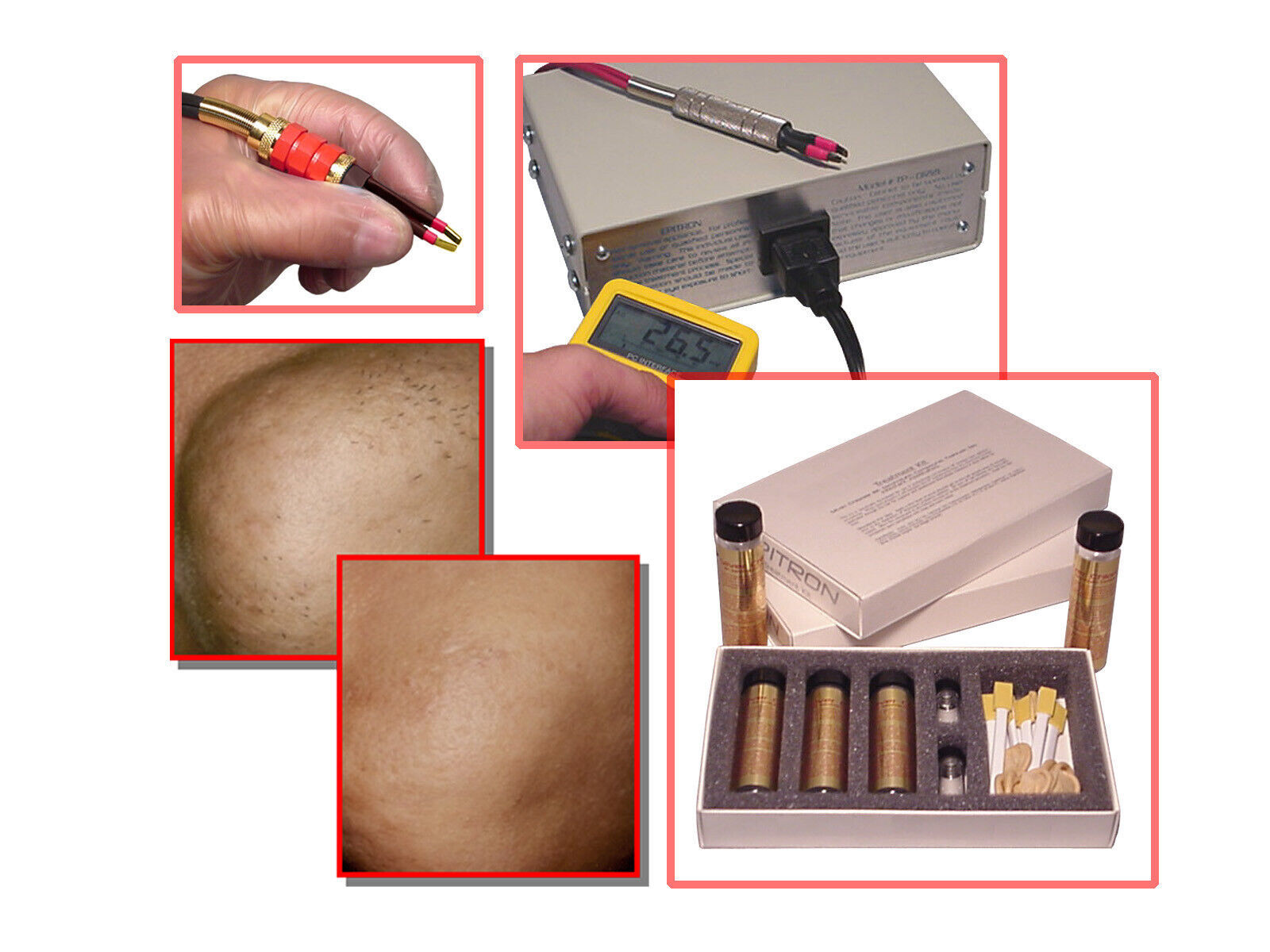 All New Electric Tweezer System Permanent Hair Removal, Chin Legs Chest